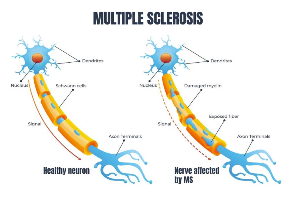 CBD para la esclerosis múltiple